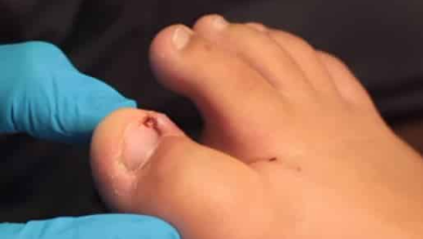 How to Drain Pus from Ingrown Toenail at Home Safely