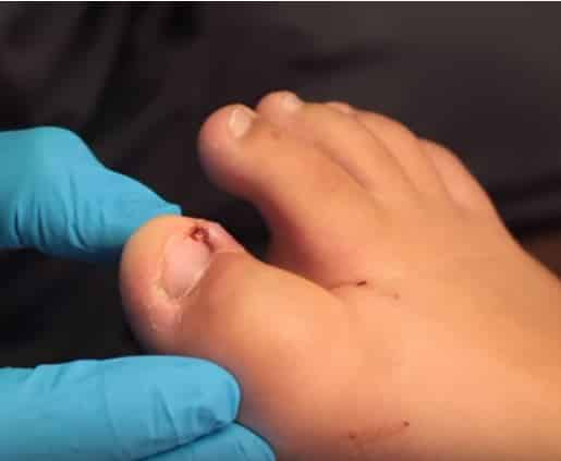 How to Drain Pus from Ingrown Toenail at Home Safely