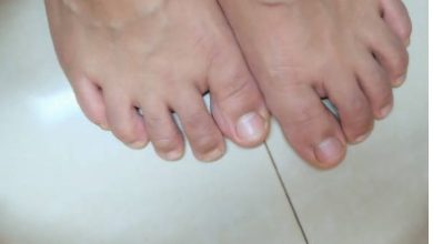 What Is Triple Arthrodesis And How Can It Benefit Your Foot Health