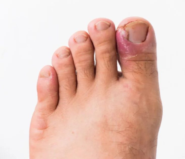 What to Expect During Your Ingrown Toenail Matricectomy Procedure