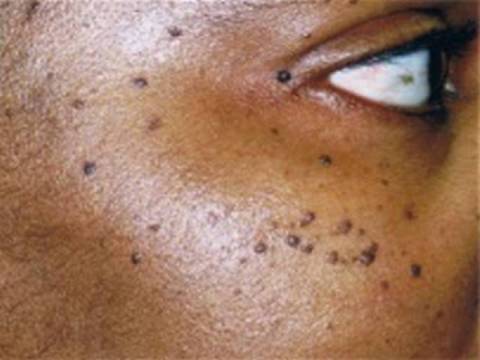 skin tags pictures 480x480 ce1e9b89 d900 4c0c 8ab7